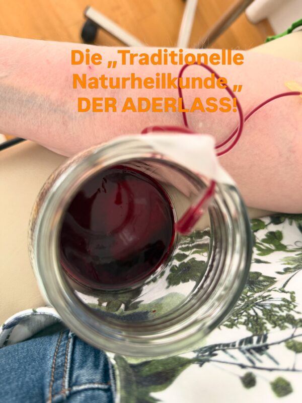Vor allem bei chronischen Krankheiten kann der Aderlass wertvolle Hilfe leisten. #krank #chronisch #blut #bluthochdruck…